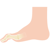 槌趾