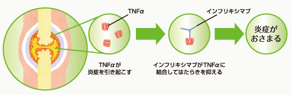 TNF-αの働きを抑えるインフリキシマブ