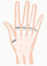 手術による治療 リウマチの治療 リウマチららら 日本化薬株式会社