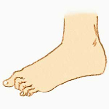 関節リウマチの症状 リウマチとは リウマチららら 日本化薬株式会社